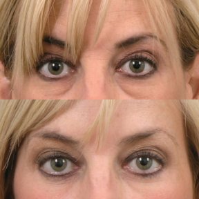 Vorher-nachher-Ergebnis der Blepharoplastik in der Cairo Plastic Clinic, Lidkorrektur