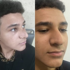 Vorher-nachher-Ergebnis der Nasenkorrektur in der Cairo Plastic Clinic, verbesserte Nasenform