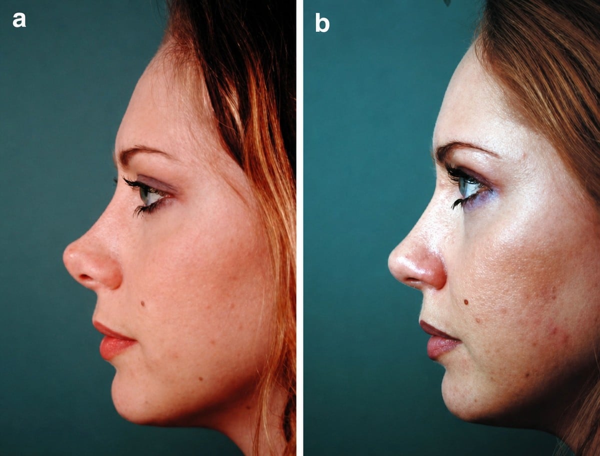 Resultados de rinoplastia antes y después en Cairo Plastic Clinic, nariz de aspecto natural