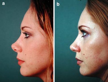 Vorher-nachher-Ergebnis der Nasenkorrektur in der Cairo Plastic Clinic, natürliche Form