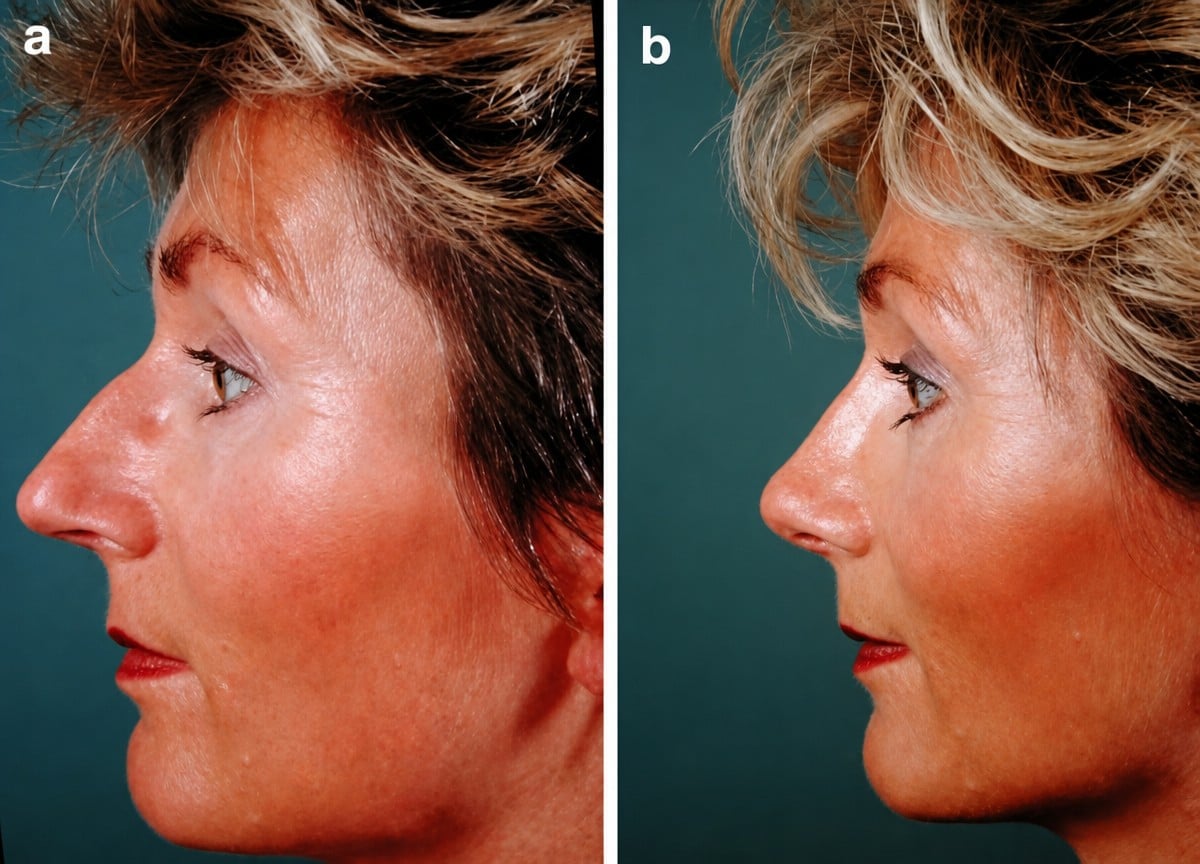 Resultados de rinoplastia antes y después en Cairo Plastic Clinic, mejora de forma y perfil nasal