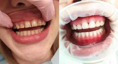 Before and after veneers at Smile Dentica Clinic, visible smile transformation result