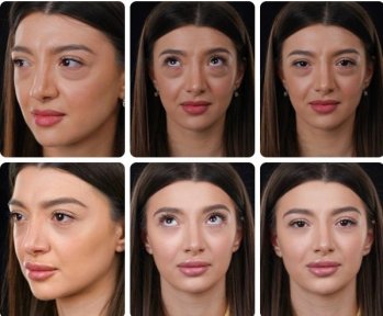 Facelift before and after results at Yurchenko Plastic Surgery Team, facial rejuvenation outcome