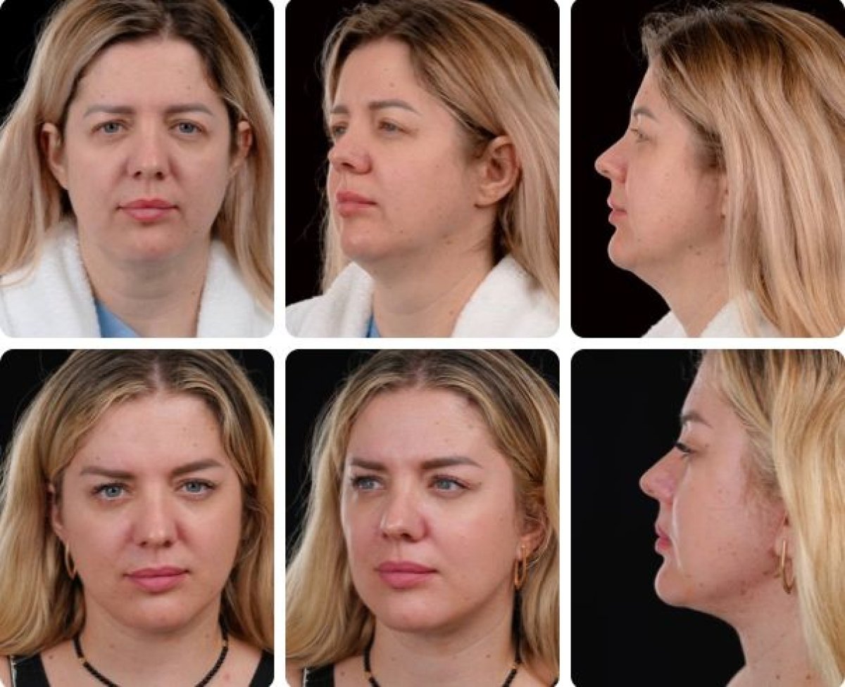 Resultados de lifting facial antes y después en Yurchenko Plastic Surgery Team, rejuvenecimiento facial