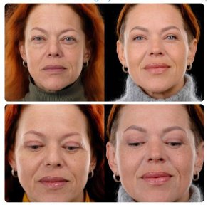 Facelift before and after results at Yurchenko Plastic Surgery Team, facial rejuvenation visible