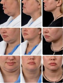 Facelift before and after results at Yurchenko Plastic Surgery Team, visible jawline contour