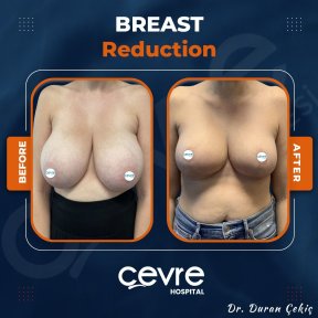 Vorher-nachher-Ergebnis Brustverkleinerung bei Adem and Havva Medical Center, sichtbare Veränderung