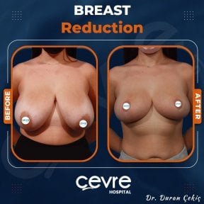 Resultados antes y después de reducción de senos en Adem and Havva Medical Center, mejor contorno