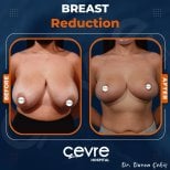 Resultados antes y después de reducción de senos en Adem and Havva Medical Center, mejor contorno
