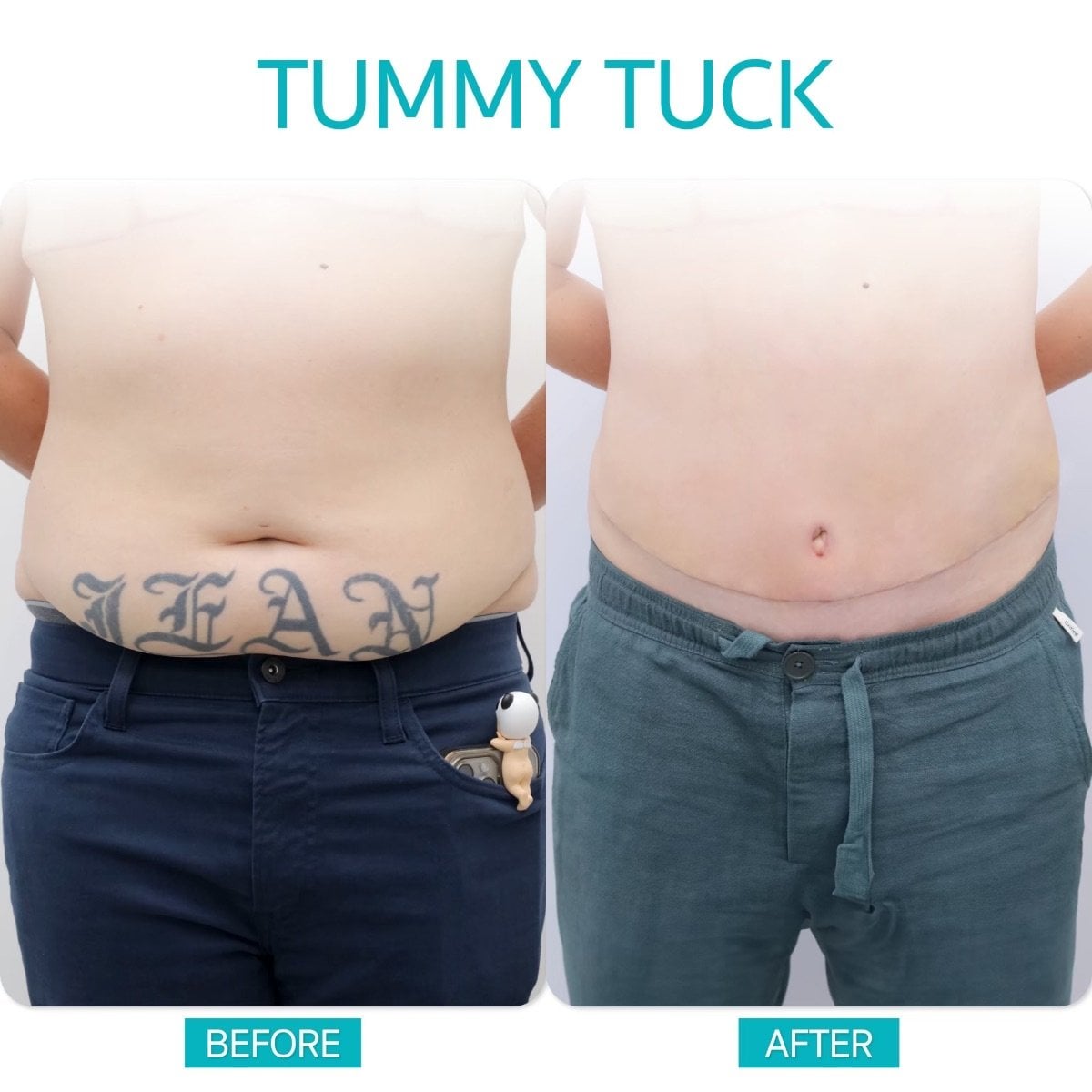 Resultados de abdominoplastia antes y después en Wansiri Hospital – mejora del contorno abdominal