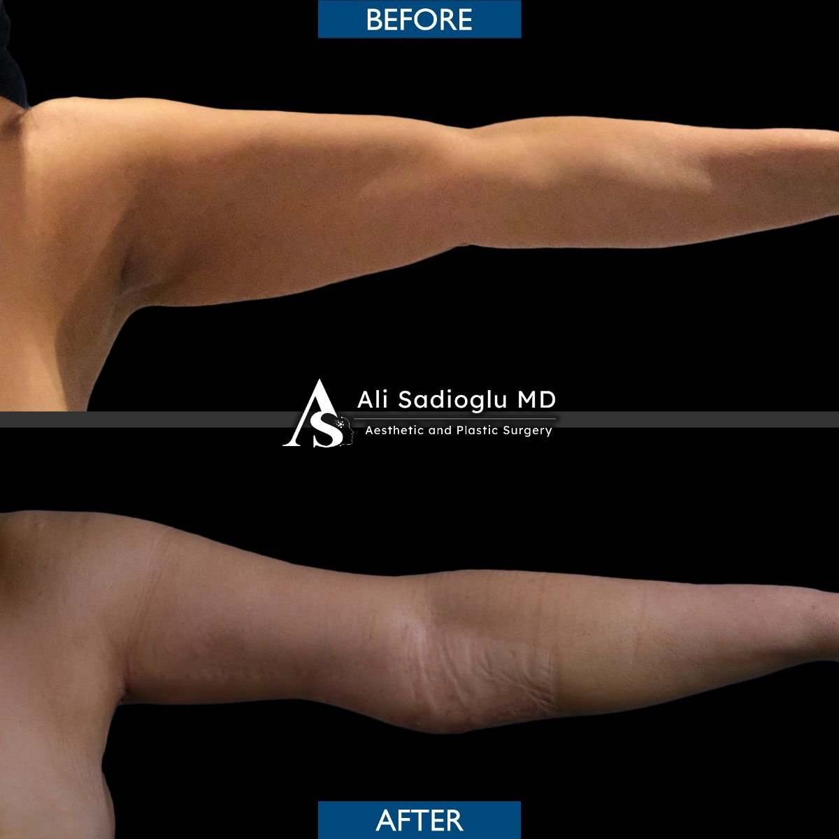 Before and after arm lift results at Dr. Safa Manav Clinic, improved arm contour visible