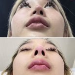 Before and after septoplasty results at Wansiri Hospital, improved nasal symmetry and airflow