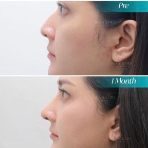 Before and after septoplasty results at Wansiri Hospital, improved nose profile after surgery