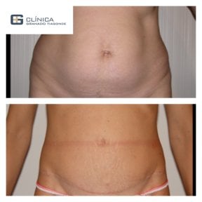 Before and after tummy tuck and liposuction results at Clinica Granado Tiagonce, flatter abdomen