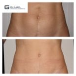 Before and after tummy tuck and liposuction results at Clinica Granado Tiagonce, flatter abdomen