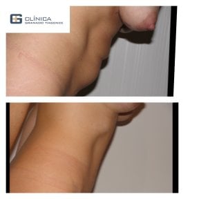Before and after tummy tuck and liposuction results at Clinica Granado Tiagonce, flatter abdomen