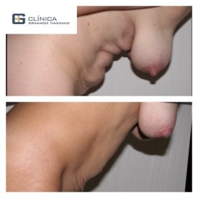 Before and after tummy tuck and liposuction results at Clinica Granado Tiagonce, abdomen contour