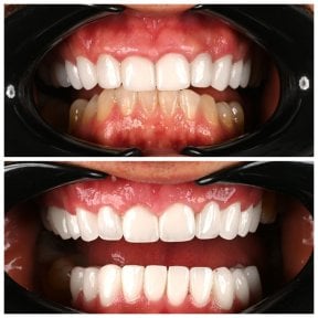 قبل وبعد تركيب تيجان الزركونيا في Soraca Med، تحول ملحوظ في الابتسامة