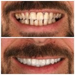 قبل وبعد تركيب تيجان الزركونيا في Soraca Med – نتيجة تحول الابتسامة