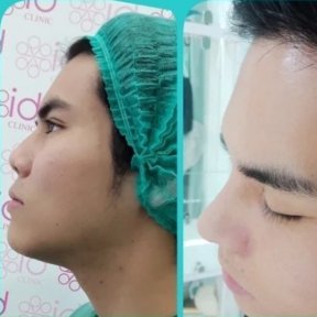 Before and after rhinoplasty results at ID Clinic Bangkok, improved nose shape and profile
