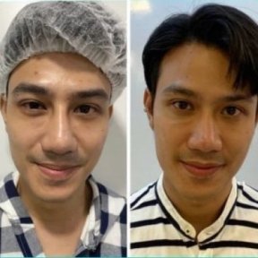 Before and after rhinoplasty results at ID Clinic Bangkok, improved nose shape and symmetry
