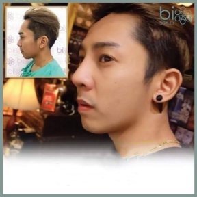 Before and after rhinoplasty results at ID Clinic Bangkok, improved nose profile and shape
