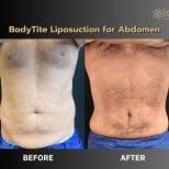 Before and after BodyTite body contouring for abdomen at ID Clinic Bangkok, visible result