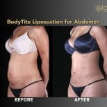 Before and after BodyTite liposuction for abdomen at ID Clinic Bangkok, body contouring result