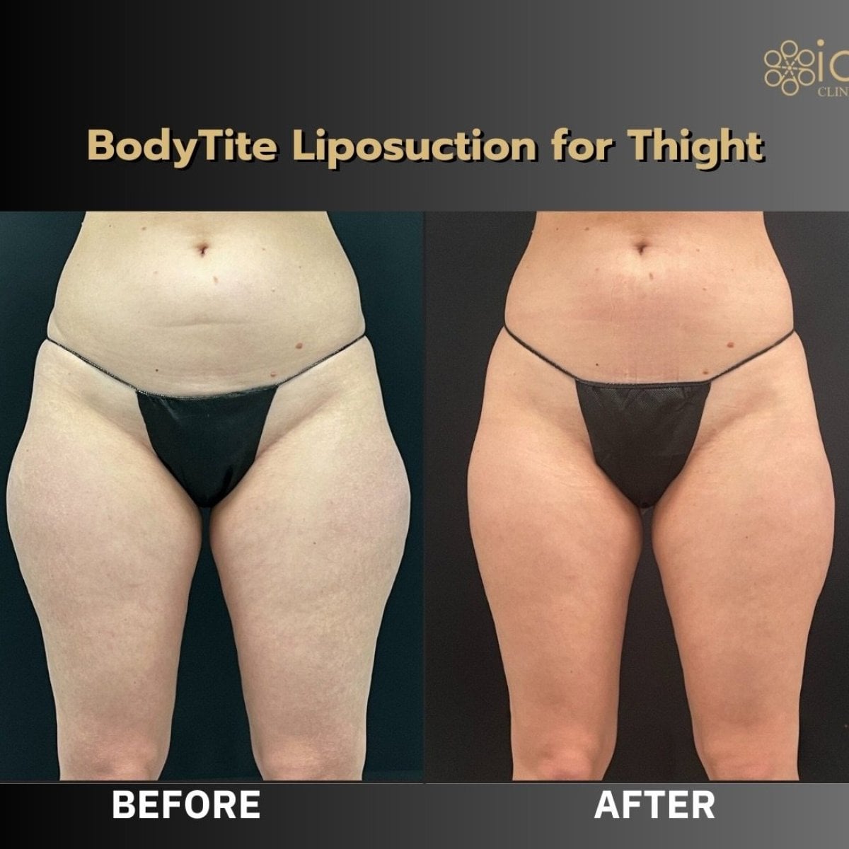 Resultados de liposucción de muslos BodyTite antes y después en ID Clinic Bangkok, contorno corporal