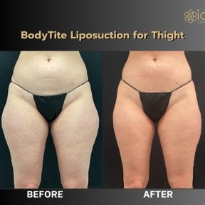 Before and after BodyTite thigh liposuction results at ID Clinic Bangkok, body contouring