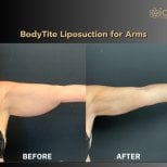 Before and after BodyTite arm liposuction results at ID Clinic Bangkok, improved contour