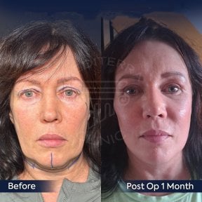 Before and after neck lift results at Dr. Safa Manav Clinic, visible facial rejuvenation