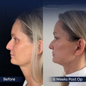 Before and after neck lift results at Dr. Safa Manav Clinic, visible jawline improvement
