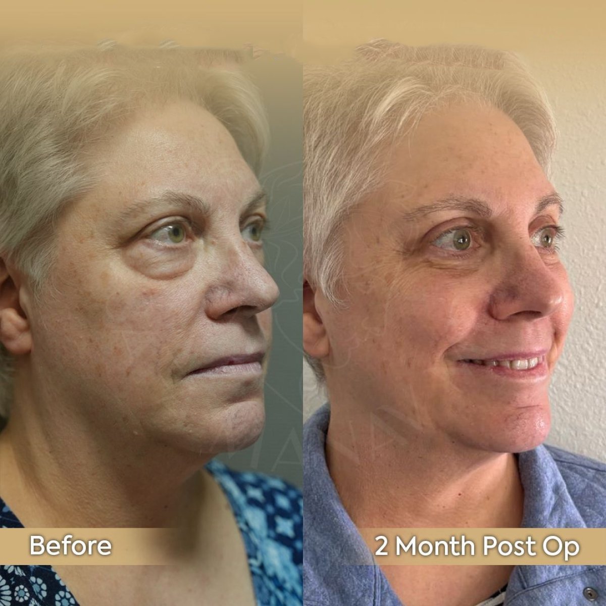 Resultados antes y después de cirugía de párpado caído en Dr. Safa Manav Clinic, 2 meses