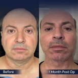 Vorher-nachher-Ergebnis Halsstraffung bei Dr. Safa Manav Clinic, sichtbare Kieferkontur