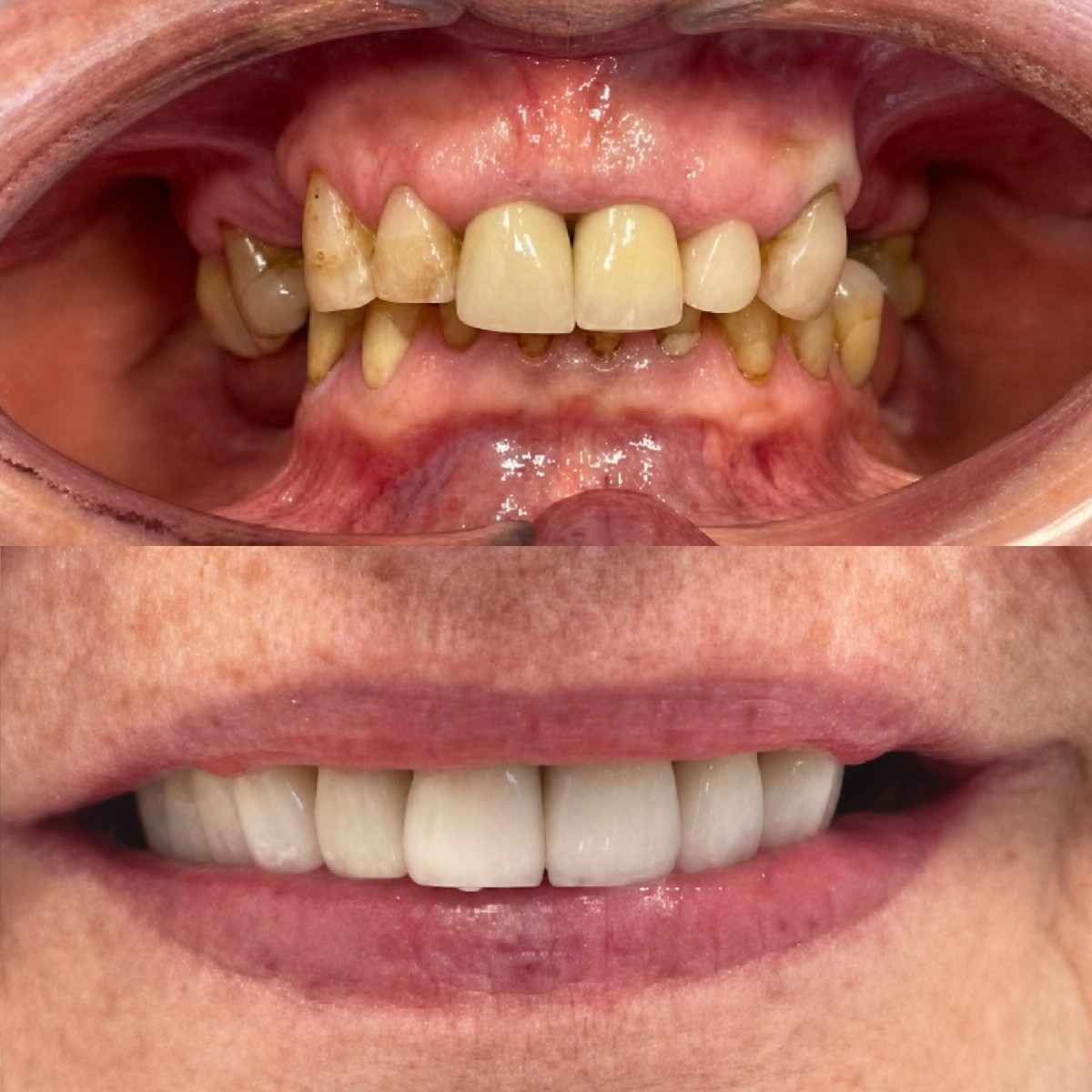 نتيجة قبل وبعد زراعة الأسنان All-on-2 في Smile Dentica Clinic، استعادة الابتسامة