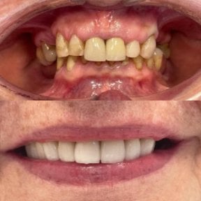 Before and after All-on-2 dental implants result at Smile Dentica Clinic, smile restoration