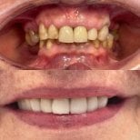 Before and after All-on-2 dental implants result at Smile Dentica Clinic, smile restoration
