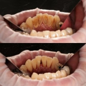 Before and after deep cleaning (scaling) results at Smile Dentica Clinic, improved oral hygiene
