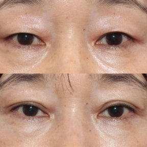Resultados de blefaroplastia antes y después en HERSHE Plastic Surgery Korea, corrección de párpados