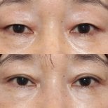 Resultados de blefaroplastia antes y después en HERSHE Plastic Surgery Korea, corrección de párpados