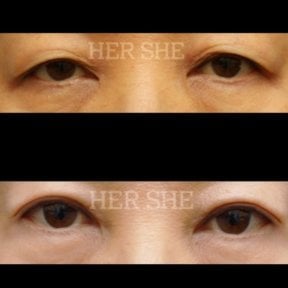 Resultados de blefaroplastia antes y después en HERSHE Plastic Surgery Korea, corrección de párpados