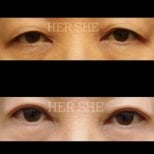 Resultados de blefaroplastia antes y después en HERSHE Plastic Surgery Korea, corrección de párpados
