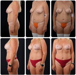 Before and after breast lift results at Yurchenko Plastic Surgery Team Kyiv, improved breast contour