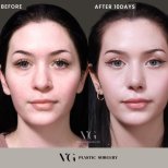 Facelift Vorher-Nachher-Ergebnis bei VG Plastic Surgery, sichtbare Verjüngung in 10 Tagen