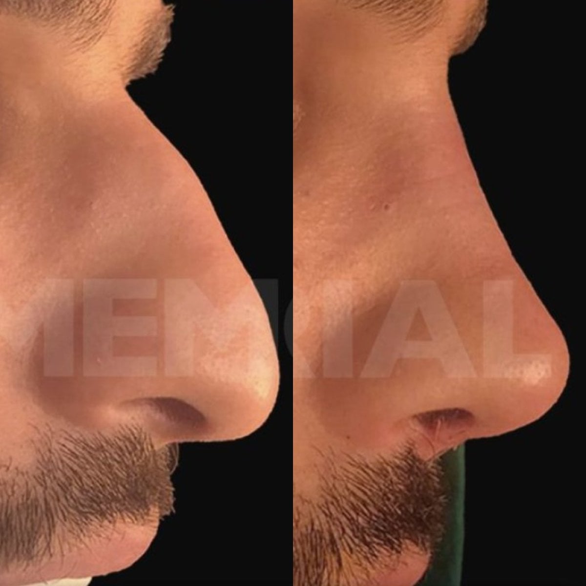 نتائج تجميل الأنف للرجال قبل وبعد في مستشفى ميموريال أنطاليا، تحسين شكل الأنف