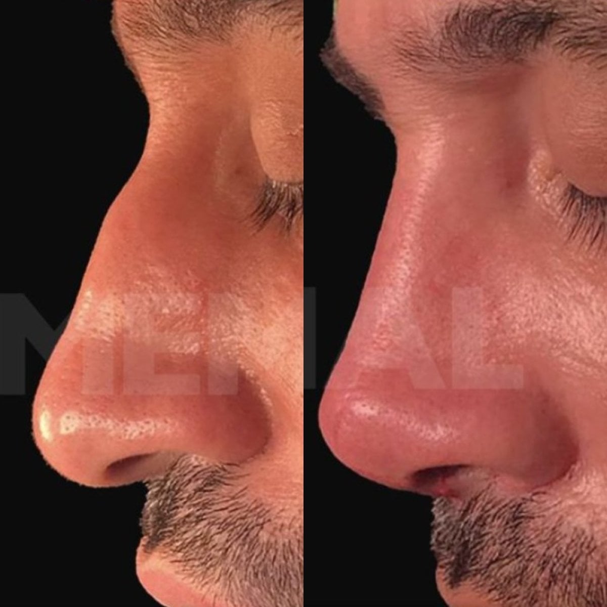 Resultados de rinoplastia masculina antes y después en Memorial Antalya Hospital, perfil mejorado