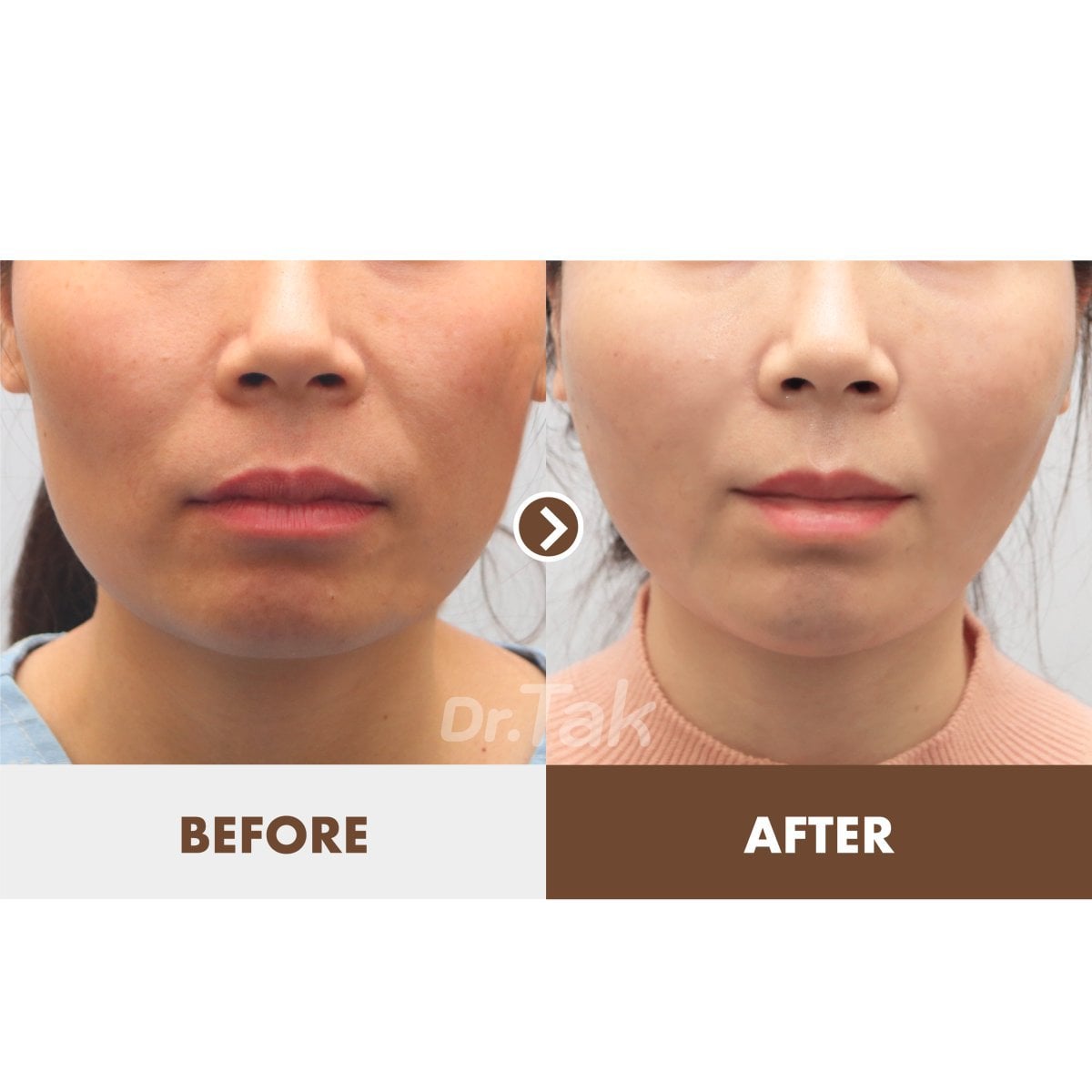 نتائج شد الوجه قبل وبعد في عيادة Dr. Tak Plastic Surgery، تجديد واضح للبشرة