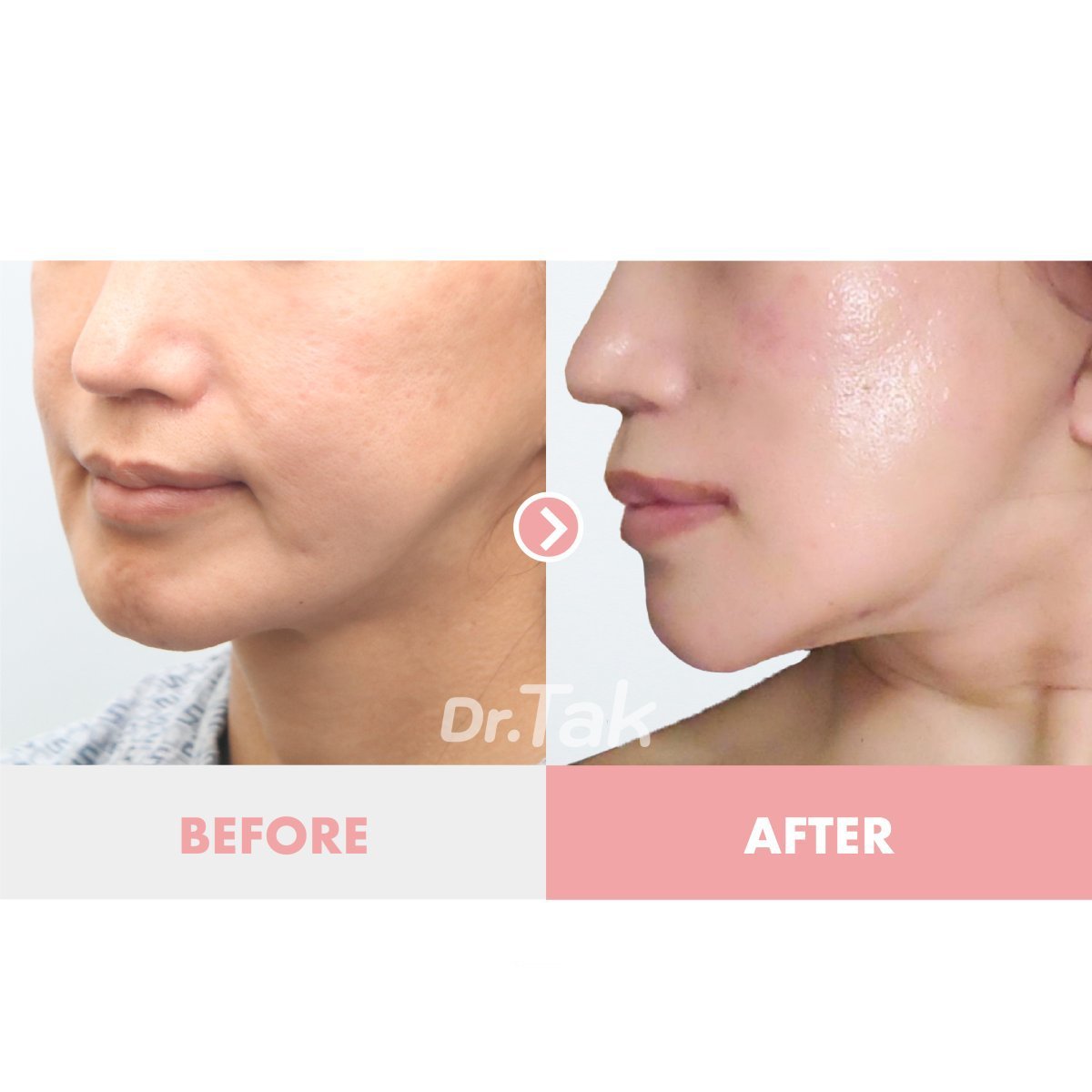 Facelift Vorher-Nachher-Ergebnis bei Dr. Tak Plastic Surgery, straffere Kieferlinie