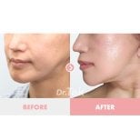 Résultats lifting visage avant/après chez Dr. Tak Plastic Surgery, mâchoire définie